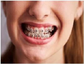 Braces / Crooked Teeth - Patelzick Family Dental