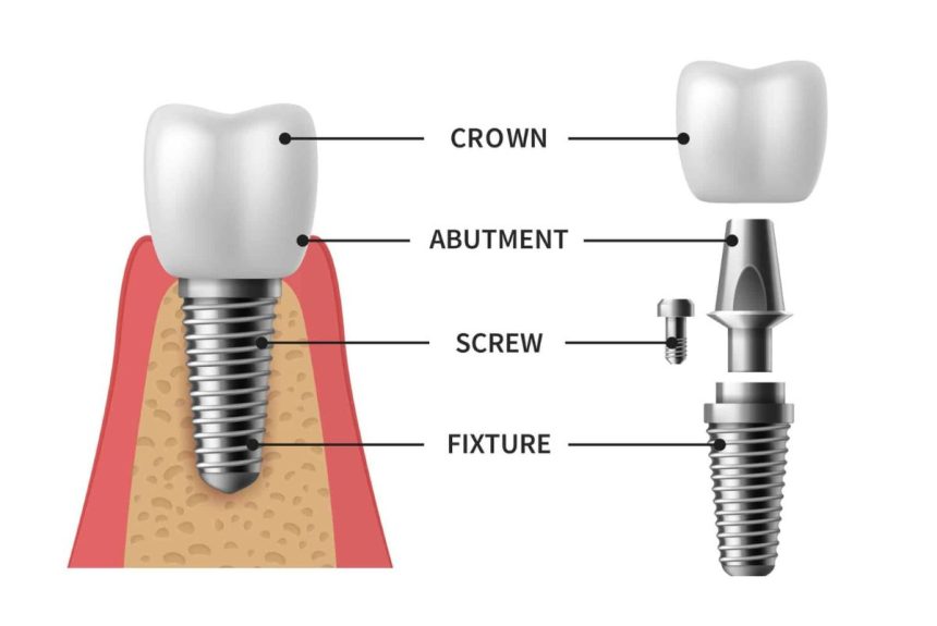 Dental Implant Close-up explaination of dental implant procedure at Casa Dentique, Seawoods, Navi Mumbai.