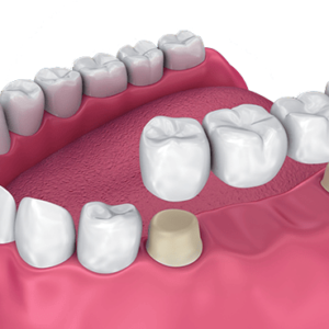 Dental Crowns & Bridges