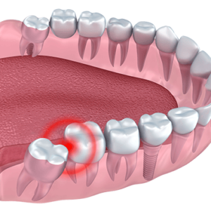 Painless wisdom tooth extraction