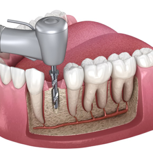 Root Canal Treatment