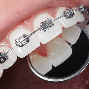 Teeth Braces & Aligners Treatment