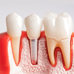 Dental Implants