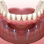 6/8 dental implants in navi mumbai