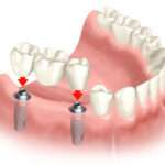 Multiple teeth implants in navi mumbai