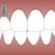 Full Mouth Implant Rehabilitation: Restoring Your Smile and Functionality