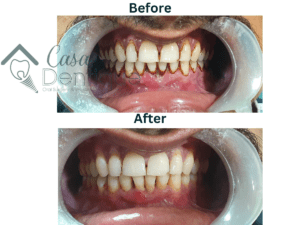 Teeth cleaning & polishing | Casadentique