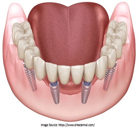 Full Mouth Implant Rehabilitation