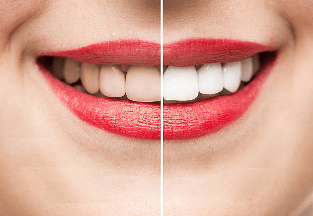 Teeth Cleaning and Whitening Same Day - Is It Possible? | Casa dentique