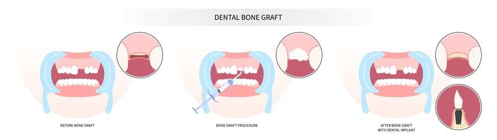 types-of-bone-grafts