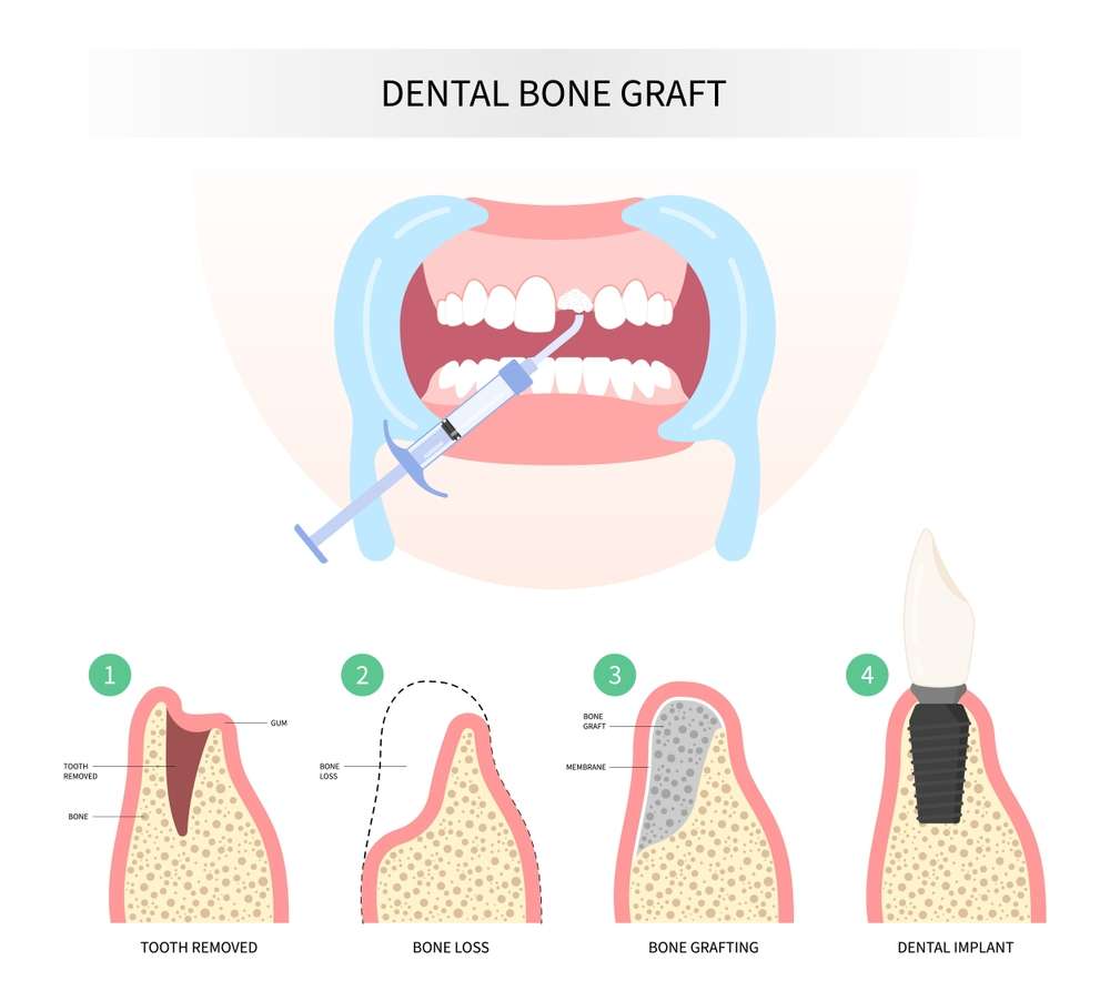 benefits-of-bone-graft