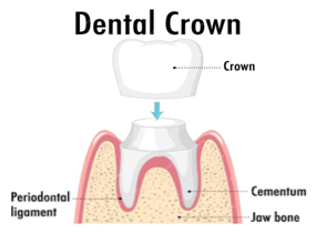 dental-crown-treatment