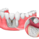 tooth-extraction-with-bone-graft