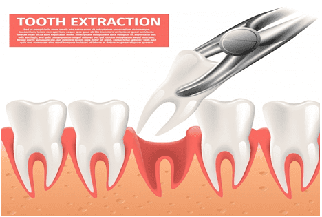 types-of-tooth-extraction