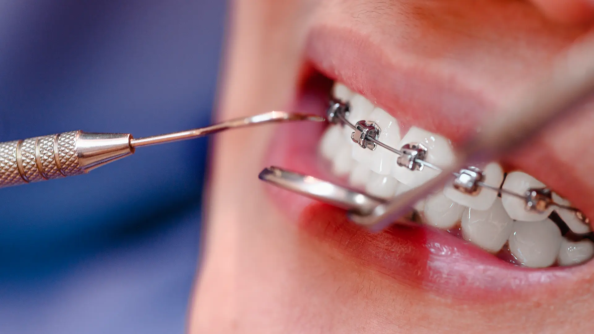 Orthodontist Seawoods Navi Mumbai braces Invisalign